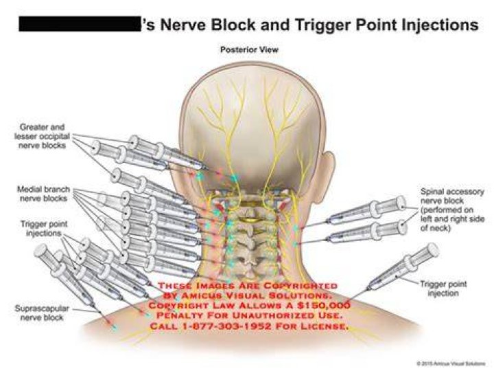 Are trigger point injections the same as nerve blocks?