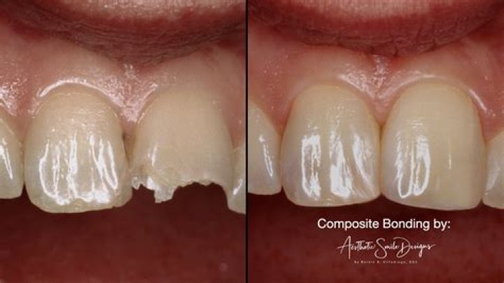 Can I drink red wine with composite bonding?
