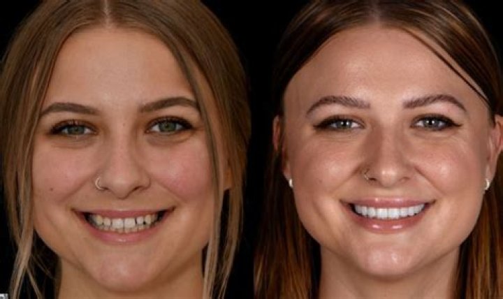 Can veneers make your face look longer?