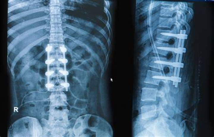 Can you feel the hardware after spinal fusion?