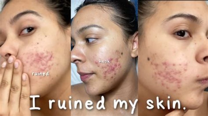 Does crying ruin skin?