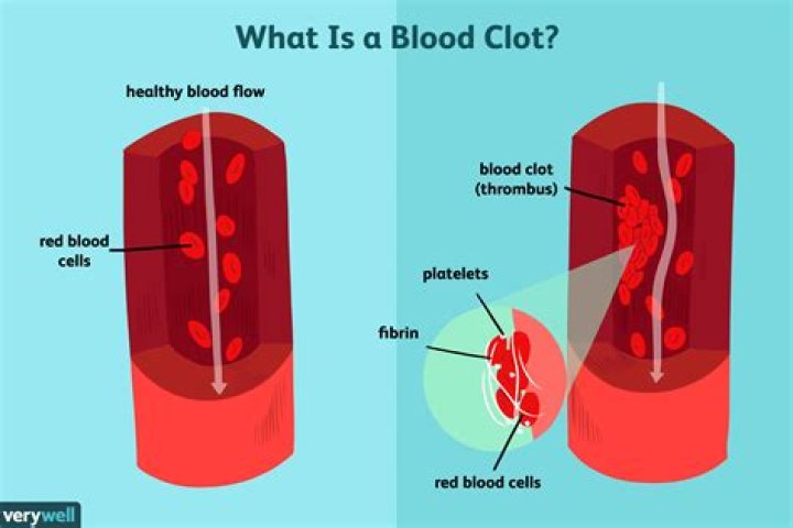 Does elevation affect blood clots?