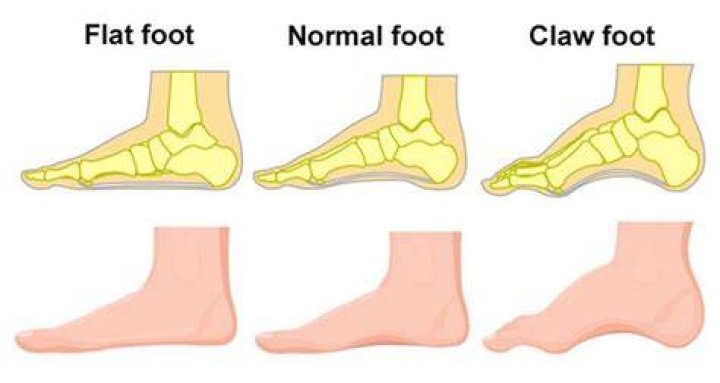 Does flat feet make you slower?
