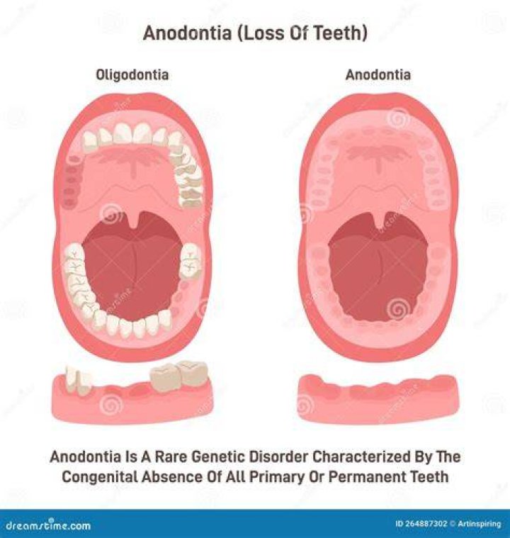 How common is anodontia?
