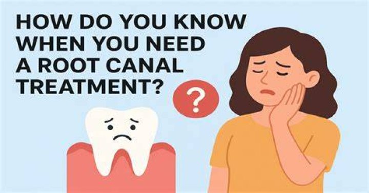 How do you know if you need root canal?