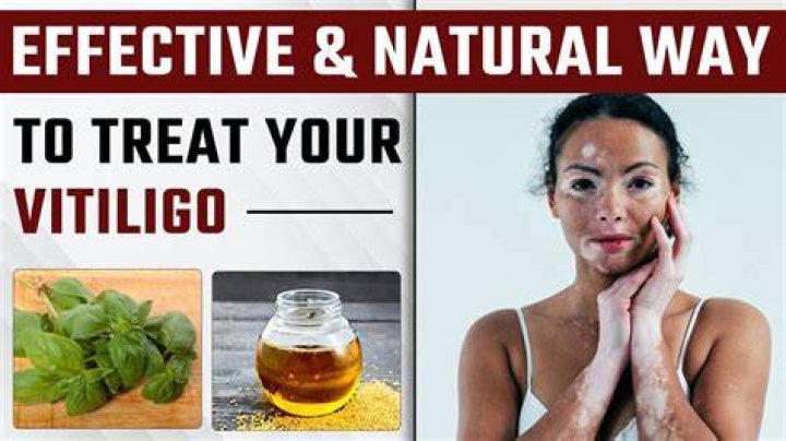 How do you stop vitiligo from spreading naturally?