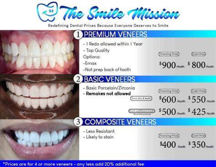 How much do veneers cost on top?