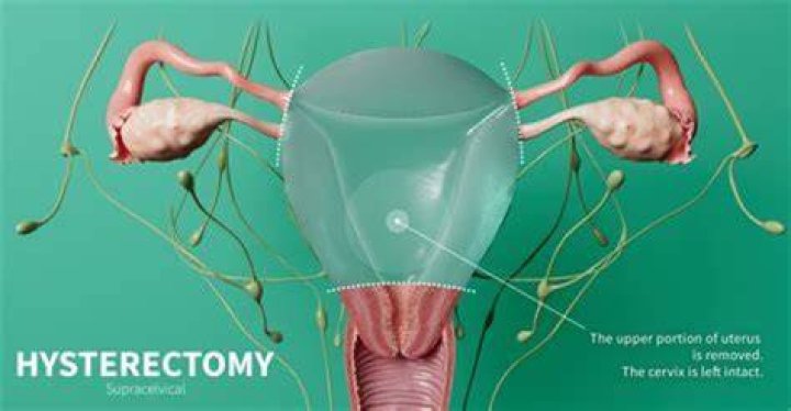How should you lay in bed after a hysterectomy?