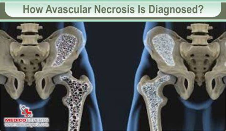 Is walking good for avascular necrosis?