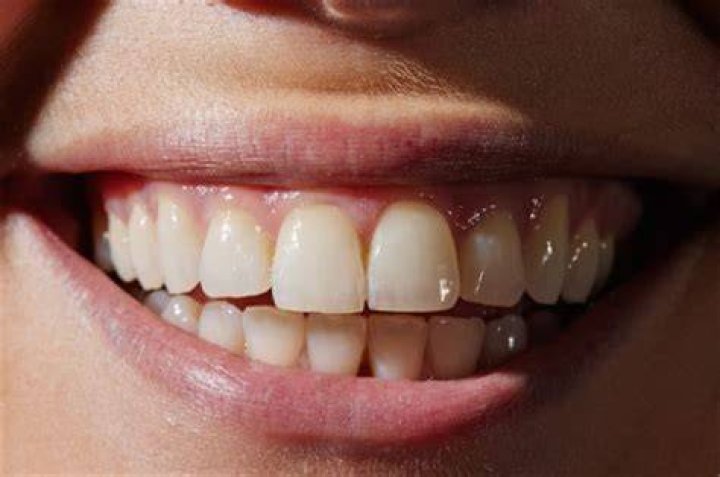 Should teeth be completely white?