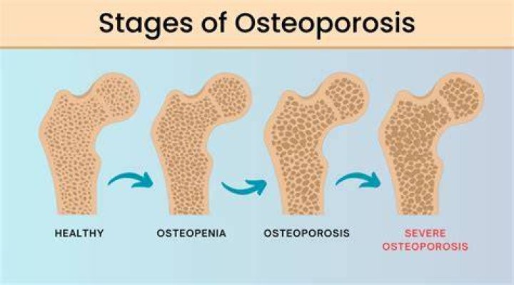 What are the three stages of osteoporosis?