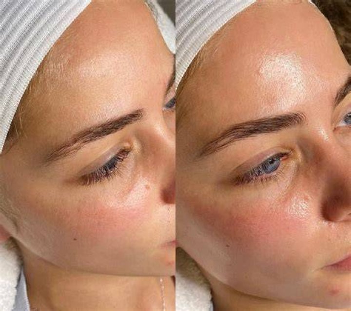 What is a HydraFacial with Dermaplaning?