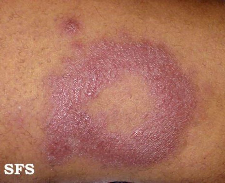 What is borderline leprosy?