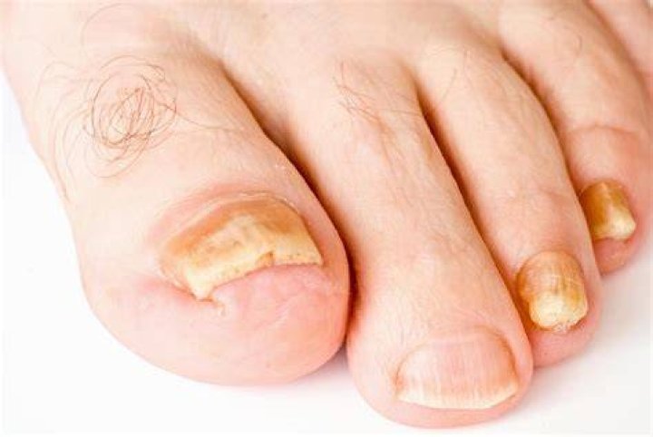 Why are my toenails discolored?